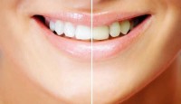 Diş Çürüğü Oluşumunu Arttırıcı Etkenler Nelerdir?