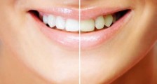 Diş Çürüğü Oluşumunu Arttırıcı Etkenler Nelerdir?